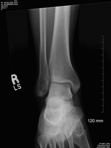 ankle-xray Ankle X-ray